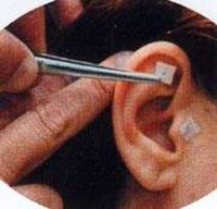 Auriculoterapia
